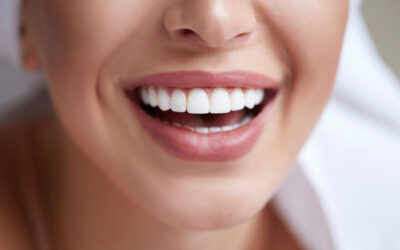 A Comprehensive Guide to Veneers | Cosmetic Dentist Castle Hill