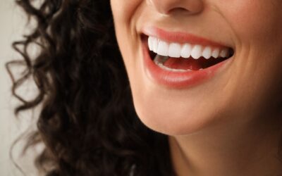 How Long Veneers Can Last