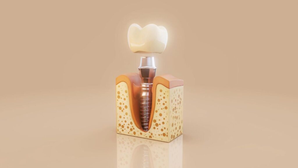 All-on-4 vs All-on-6 Dental Implants in Castle Hill