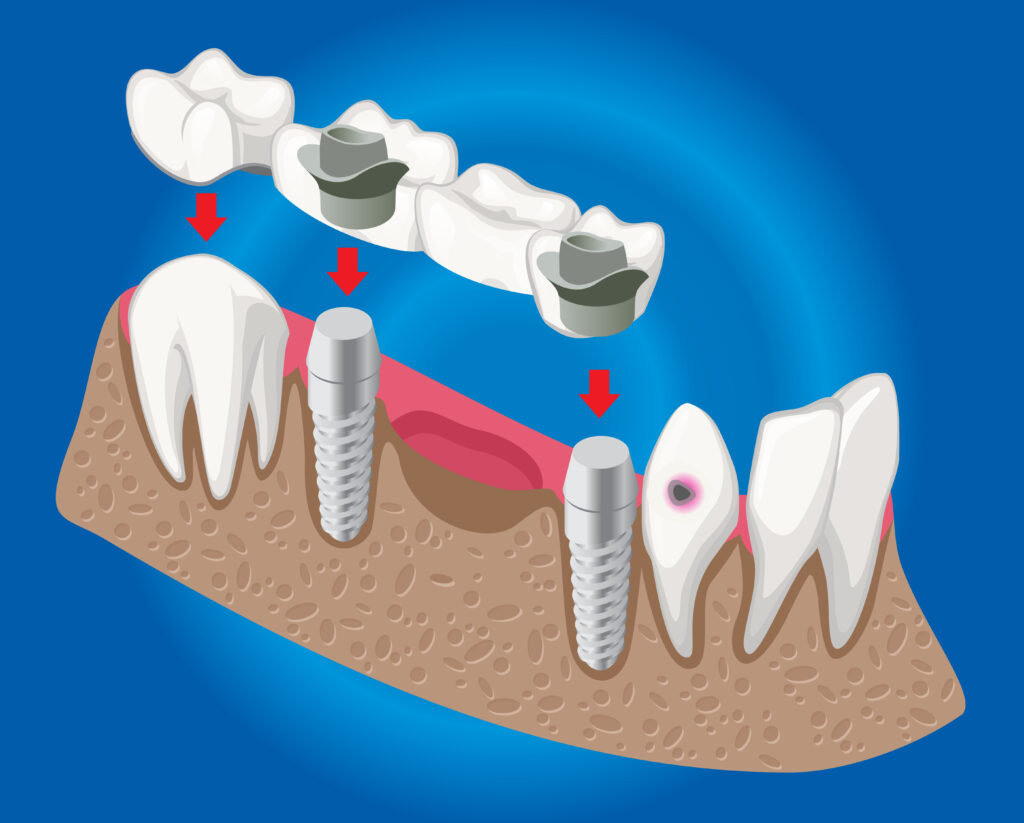 Bridge, Implant or Nothing: Which Tooth Replacement Option Suits You in Castle Hill
