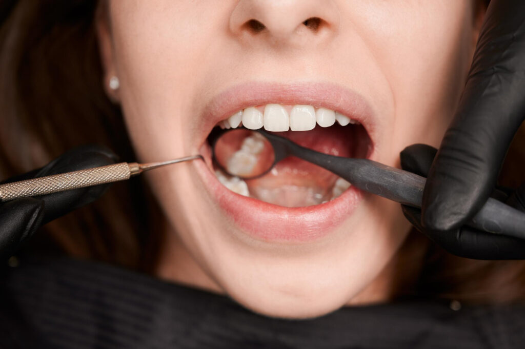 How Long Do Dental Crowns Really Last