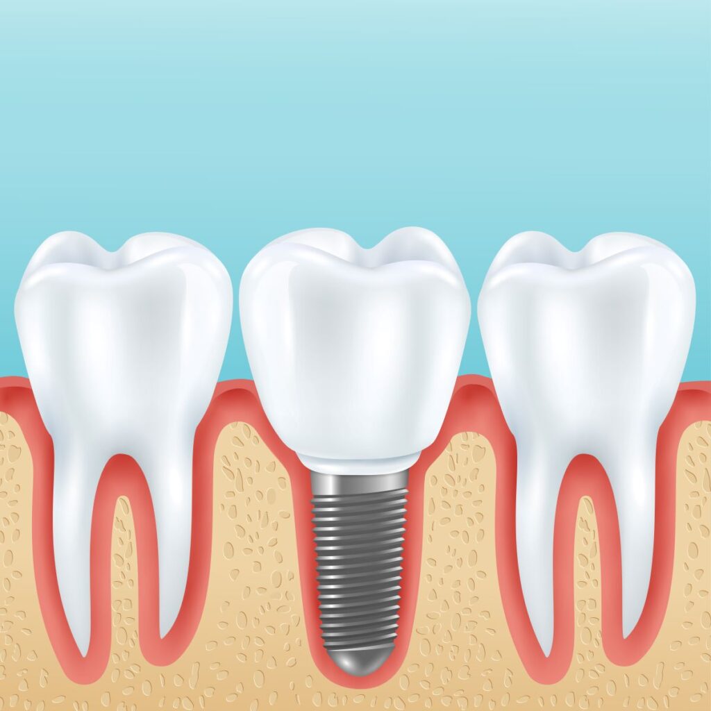 Tooth Implant Cost and Process in Castle